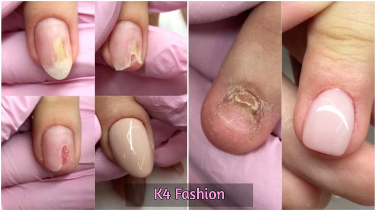 Broken Nails Transformation Pedicure Tutorials